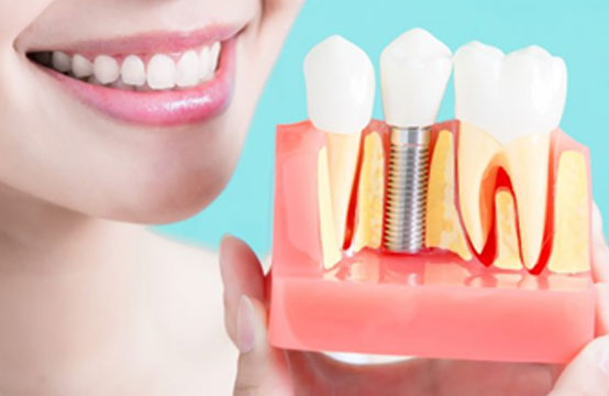 DENTAL IMPLANTS